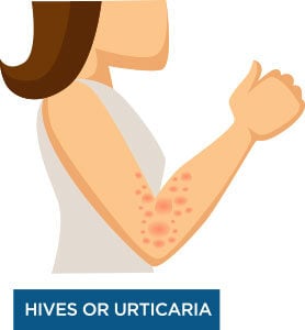 Hives Hives